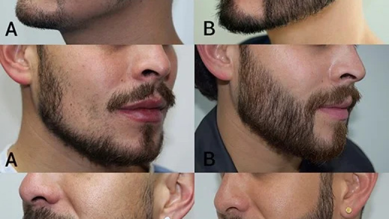 Beard Goals Achieved: Stunning Beard Transplant Before and After Cases