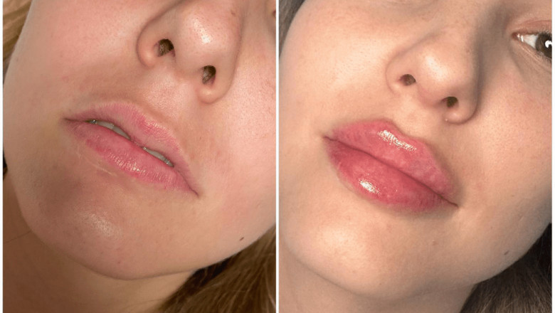 Can Dermal Fillers in Dubai Improve the Appearance of Scars?