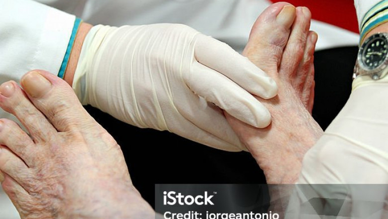 Diabetes foot ulcer ventura