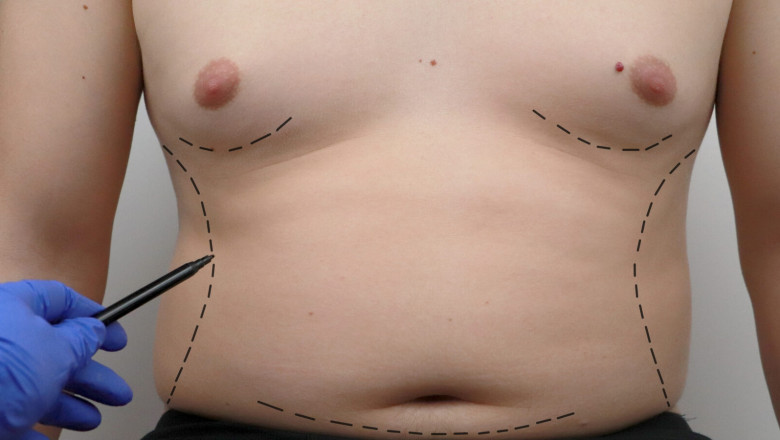 Gynaecomastia Surgery in Dubai: Quick Overview
