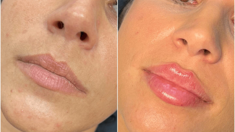 Why Experience Matters for Juvederm in Dubai Injections