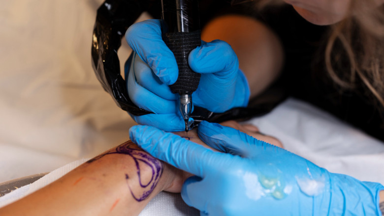 Tattoo Removal Treatment