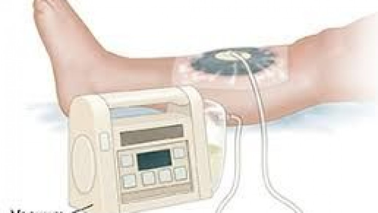 Global Negative Pressure Wound Therapy Market Outlook 2022–2032: Trends &amp; Forecast