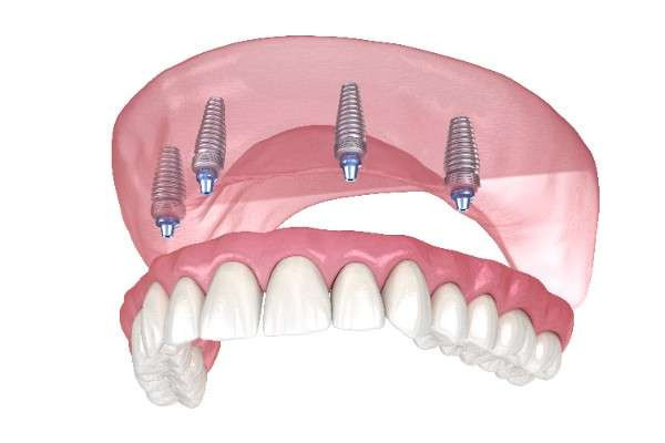 Dental implants Newcastle
