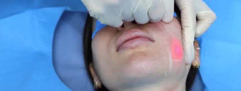 endolift
