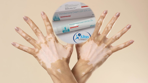 Benoquin Cream 20%: The Breakthrough Solution for Vitiligo You Need!