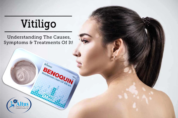 Benoquin Cream 20%: The Breakthrough Solution for Vitiligo You Need!