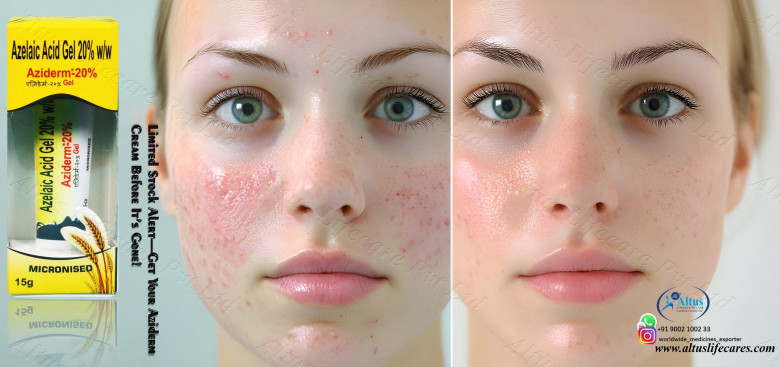 Aziderm 20 Gel: Your Secret to Clear, Glowing Skin!