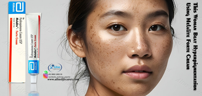 Melalite Forte Cream Review: Does It Really Work Wonders on Your Skin?
