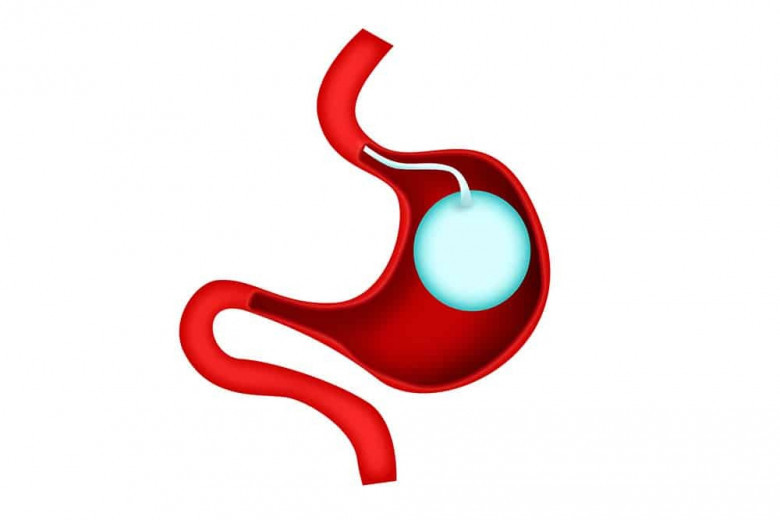 Gastric Balloon Placement in Dubai