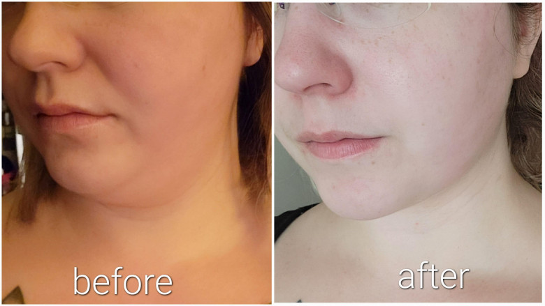 Double Chin Liposuction in Dubai