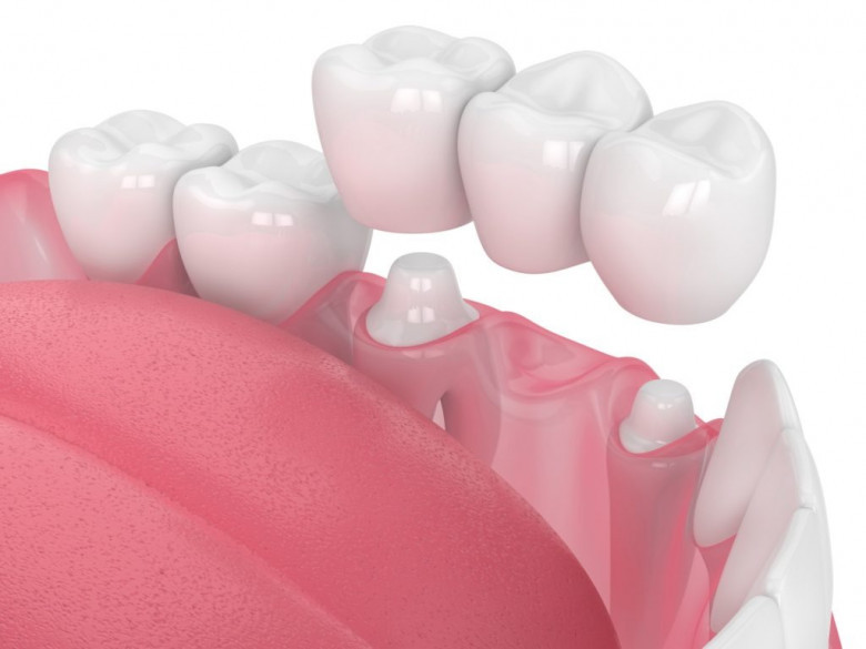 Dental Crowns and Bridges in Dubai