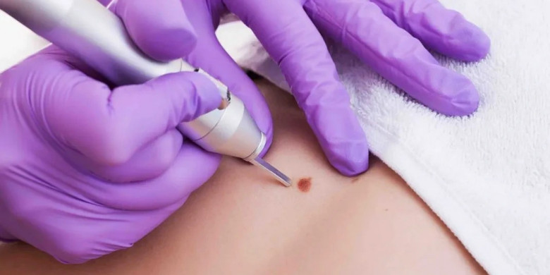 Skin Wart Removal Cost in Dubai