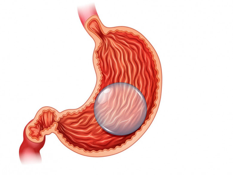 Gastric Balloon Placement in Dubai