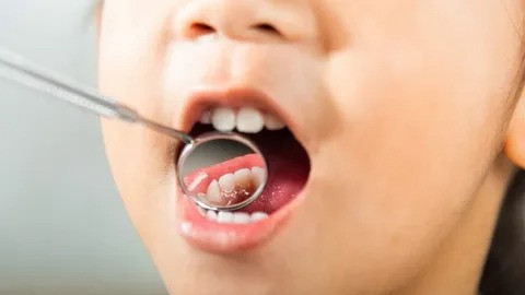 Pediatric dentist placing a dental crown on a child’s tooth in Parker, CO