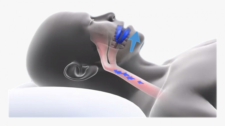 Anti Snoring Devices And Snoring Surgery Market Strategic Moves Transforming The Sleep Health Industry