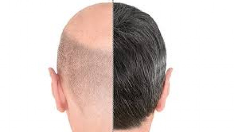 Hair Transplant Dubai/Tajmeels