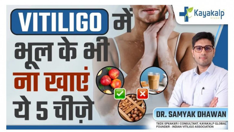 बच्चों के चेहरे पर सफेद दाग दिख रहा है एक भी निशान, तो न करें नजरअंदाज