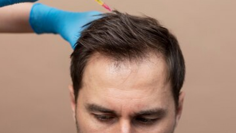 Alopecia Market: Innovations in Treatment & Care
