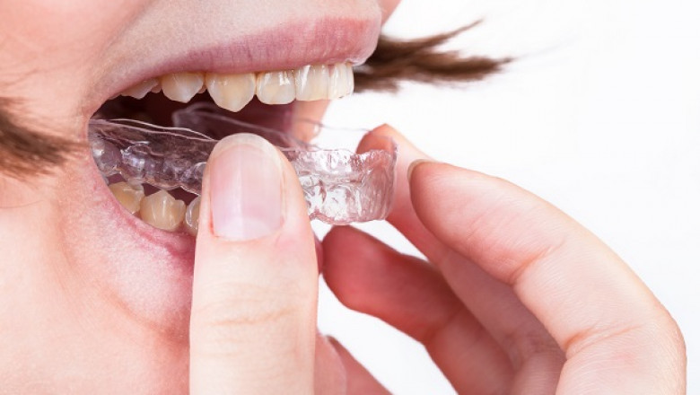 Invisalign Cost for Adults: What Are Your Options?
