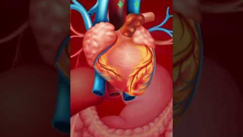 Coronary Artery Bypass Grafting Market is driven by rising cardiovascular diseases