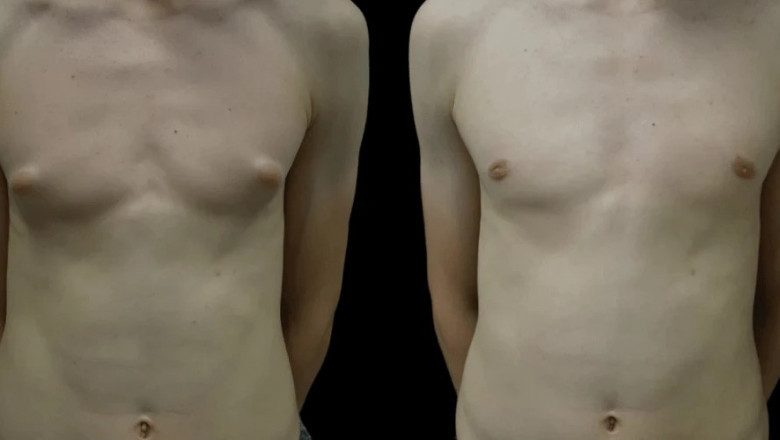 Gynecomastia Surgery in Dubai: How to Prepare for a Smooth Experience
