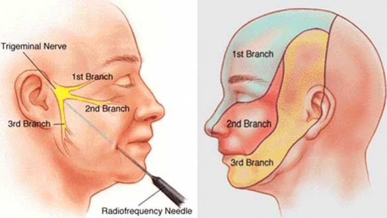 Neuralgia Treatment: Managing Pain From Damaged Nerves