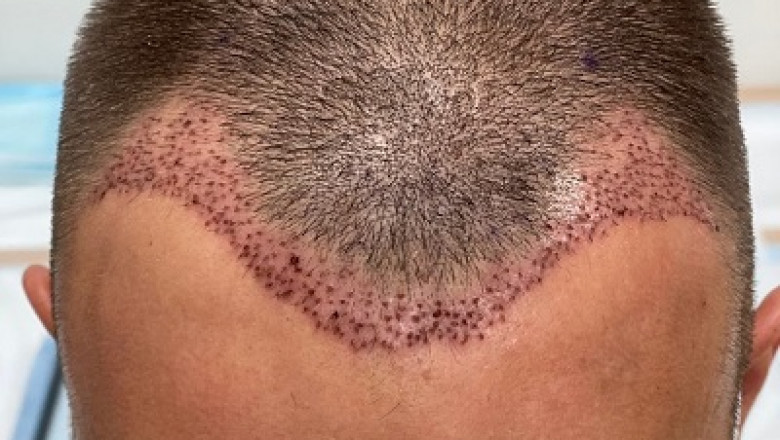 How to Choose the Right Clinic for Your Hair Transplant