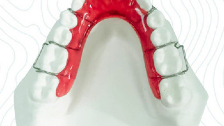 Why Retainers Matter: The Role Of Begg Wraparound Retainers