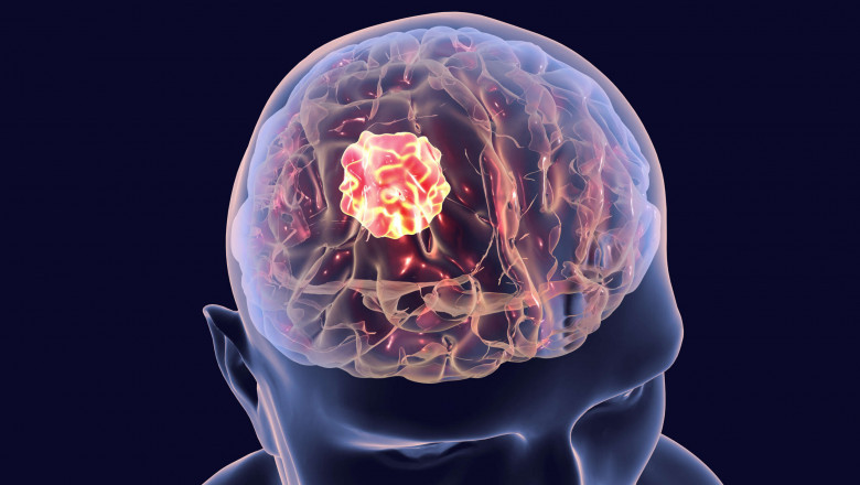 Brain Tumor Diagnosis & Therapeutics Market: The Role of Artificial Intelligence in Revolutionizing Brain Tumor Diagnosis