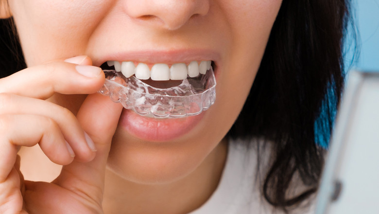 Discover the Hidden Costs of Invisalign You Should Be Aware Of