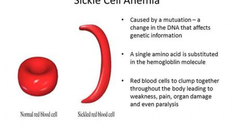 Fighting Sickle Cell Anemia with Early Detection and Screening