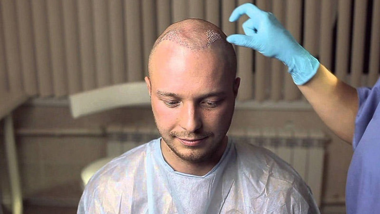 Hair Growth Timeline After a Dubai Hair Transplant