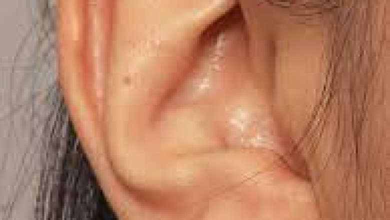 How to Fix Stretched Earlobes and Achieve Perfect Symmetry
