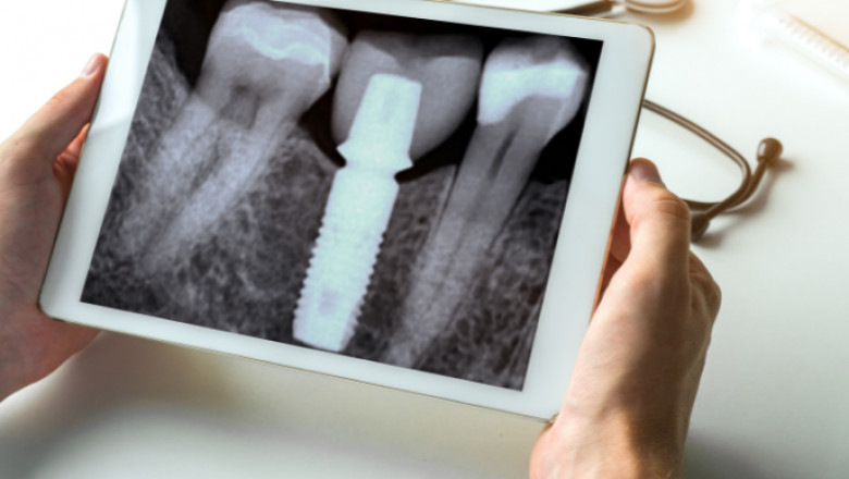 How Sedation Dentistry Is Changing the Way We Approach Oral Health