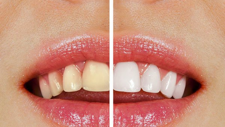 Teeth Whitening for Sensitive Teeth: Can You Achieve a Whiter Smile Without Discomfort?