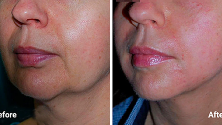 What Are The Benefits Of Morpheus8 Microneedling?