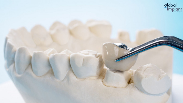 Why Dental Crowns Are a Great Choice for Your Teeth