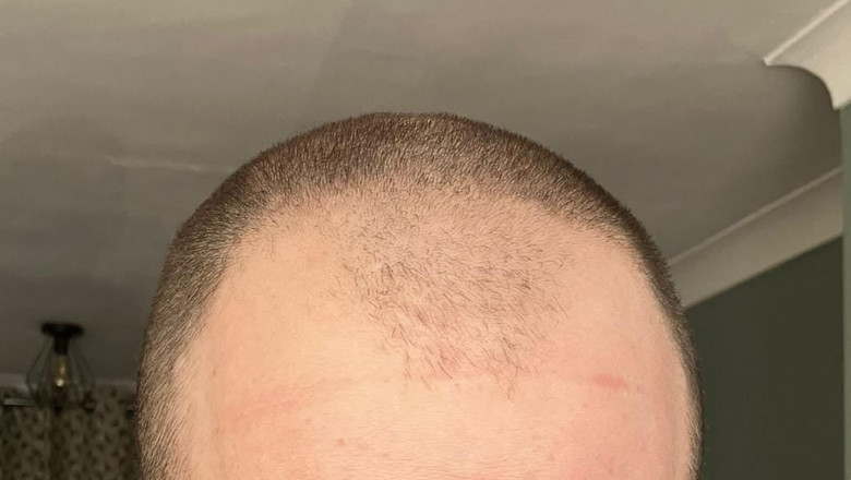 Will Insurance Cover Hair Transplant Costs?