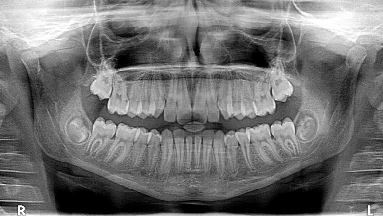 Is the Cost of a Panoramic Dental X-Ray in Dubai Worth It?