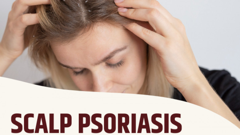 Natural Scalp Psoriasis Treatment: 5 Effective Remedies You Must Try