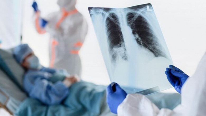 Pneumonia: Symptoms, Causes, and Prevention Guide