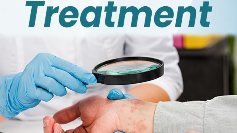 How Homeopathy Heals Psoriasis from the Root Cause