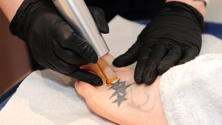Tattoo Removal in Dubai: What to Expect During Treatment