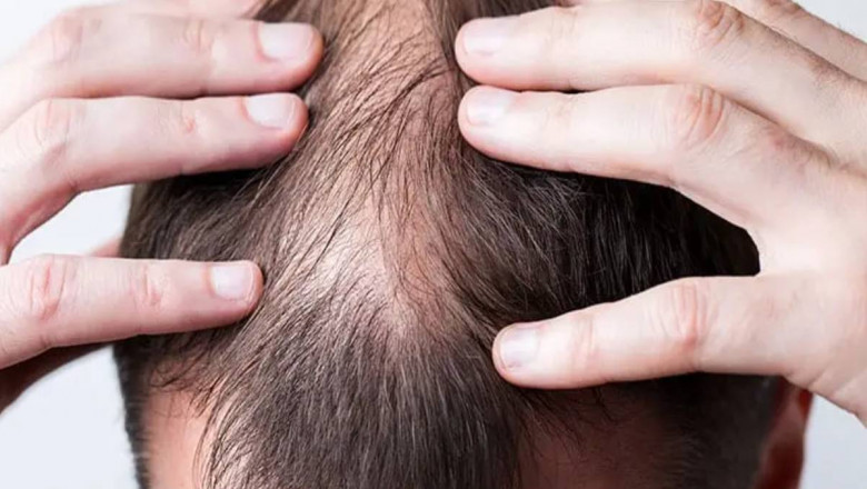 Innovative Hair Restoration in Dubai