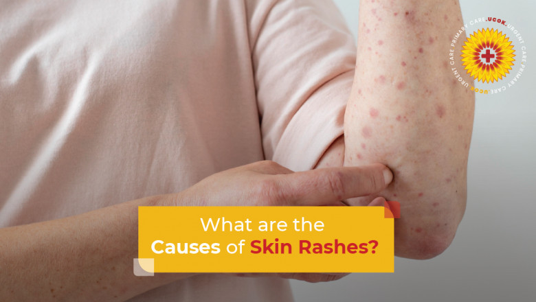 What Are the Causes of Skin Rashes?