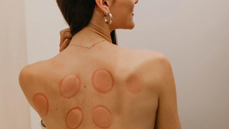 Cupping Physiotherapy Treatment In Pune | Physio 9 Clinic