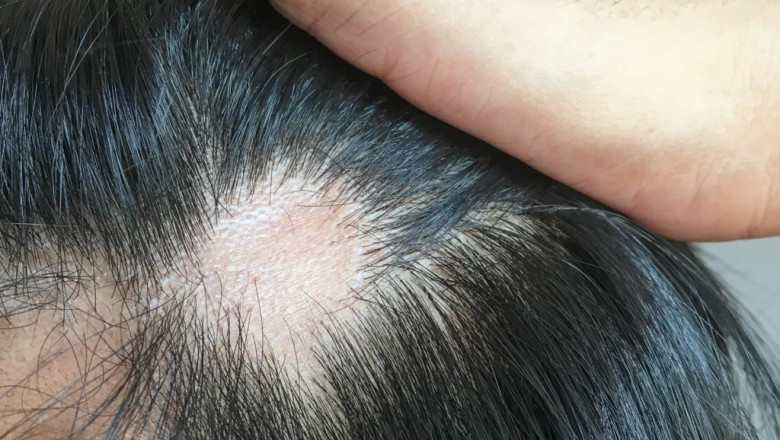 Does Finasteride Prevent Future Hair Loss?