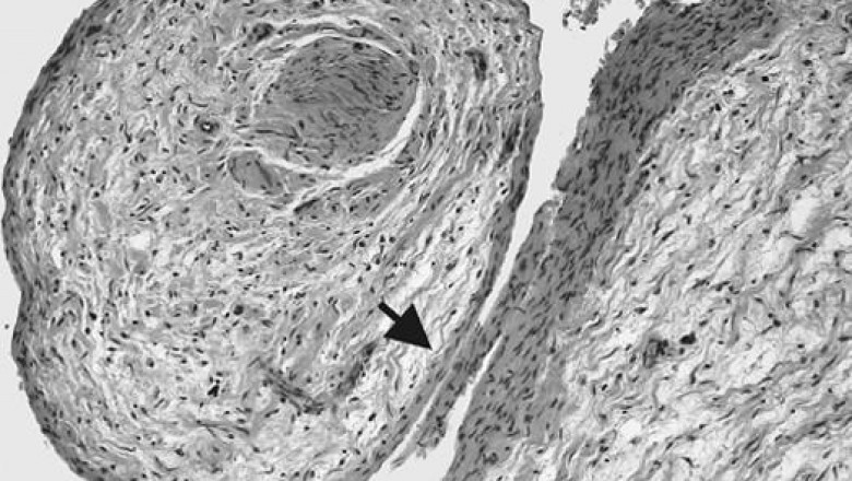 A New Era in the Management of Neurofibromatosis Type One-Associated Plexiform Neurofibromas: Promising Therapies and Market Expansion
