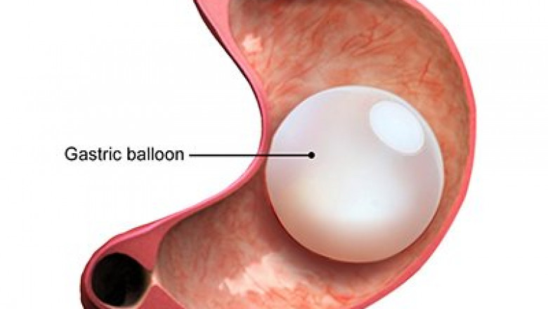 Transform Your Health with Gastric Balloon Treatment in Dubai